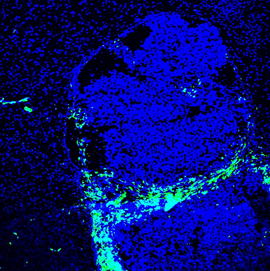 Zils – DAPI (šūnu kodoli, blīvāks krāsojums iezīmē audzēja robežas); Zaļš – CD206 (audzēju atbalstošu makrofāgu marķieris).
